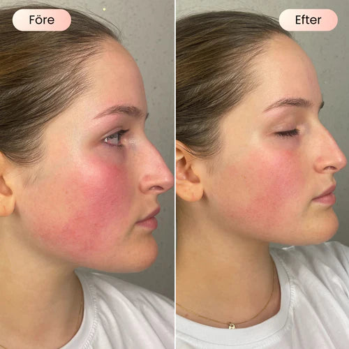 Dermalume Skinboosting LED Mask
